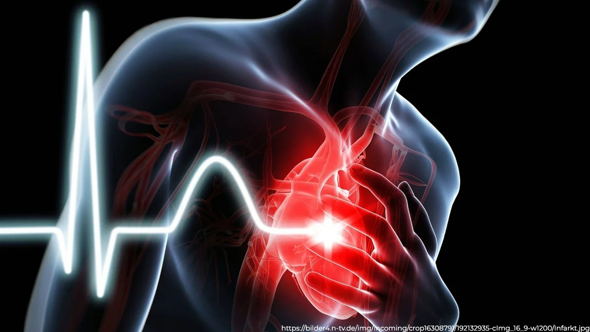 Инфаркт миокарда сердце