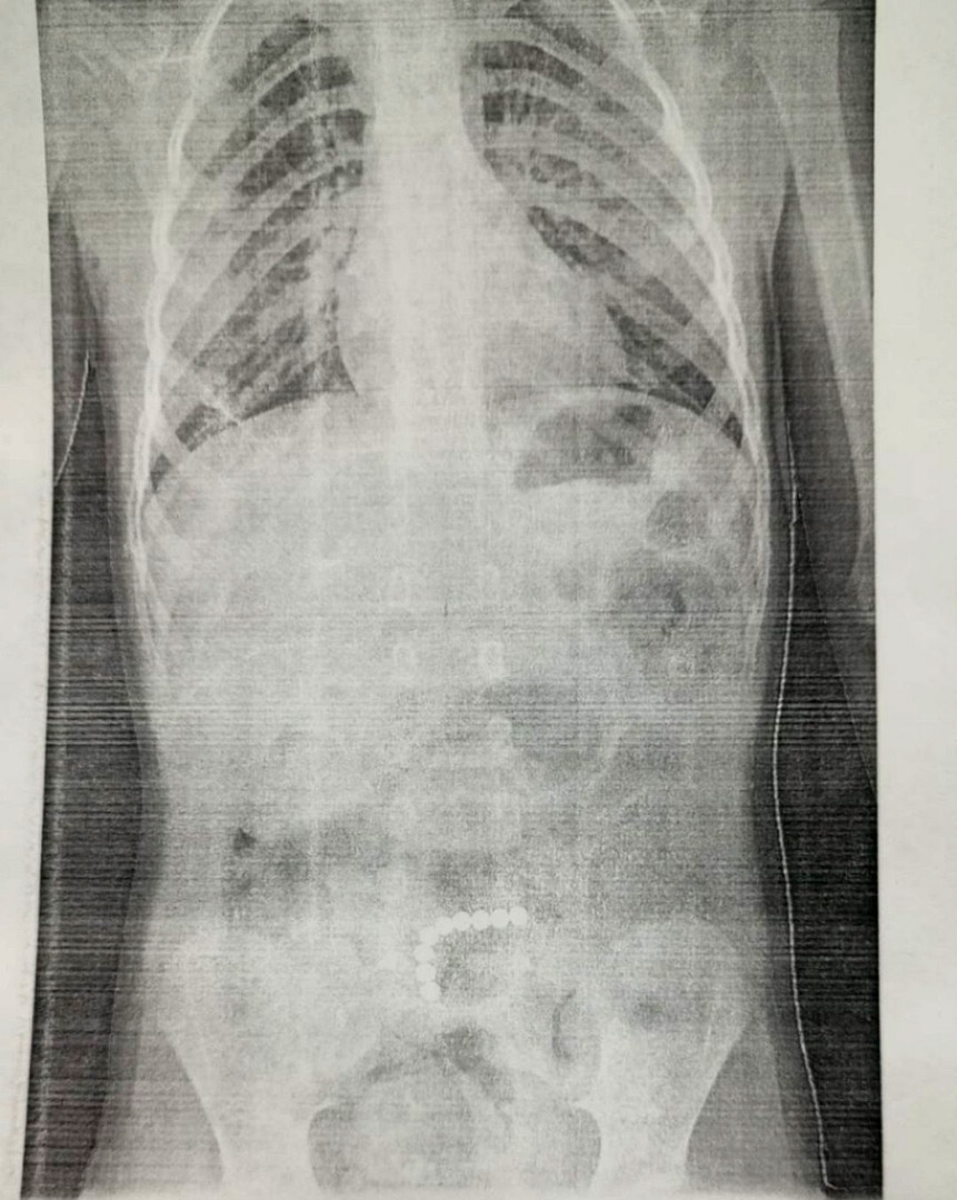 4-летний малыш проглотил 9 магнитных шариков. Врачам ОДКБ удалось его  спасти - новости Владимирской области