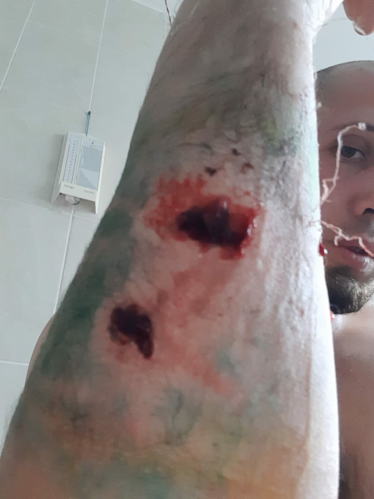 Мужчина, серьезно пострадавший от укусов алабая, требует убрать с улиц  «ходячую смерть» - новости Владимирской области