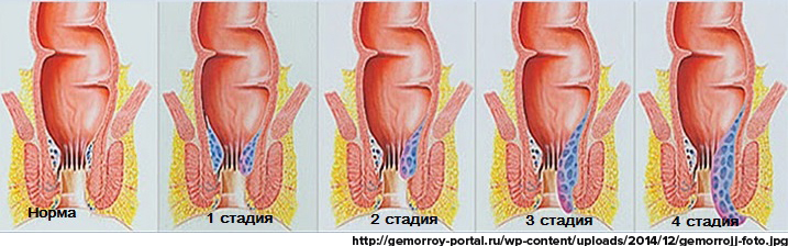 После стула вылезает геморрой