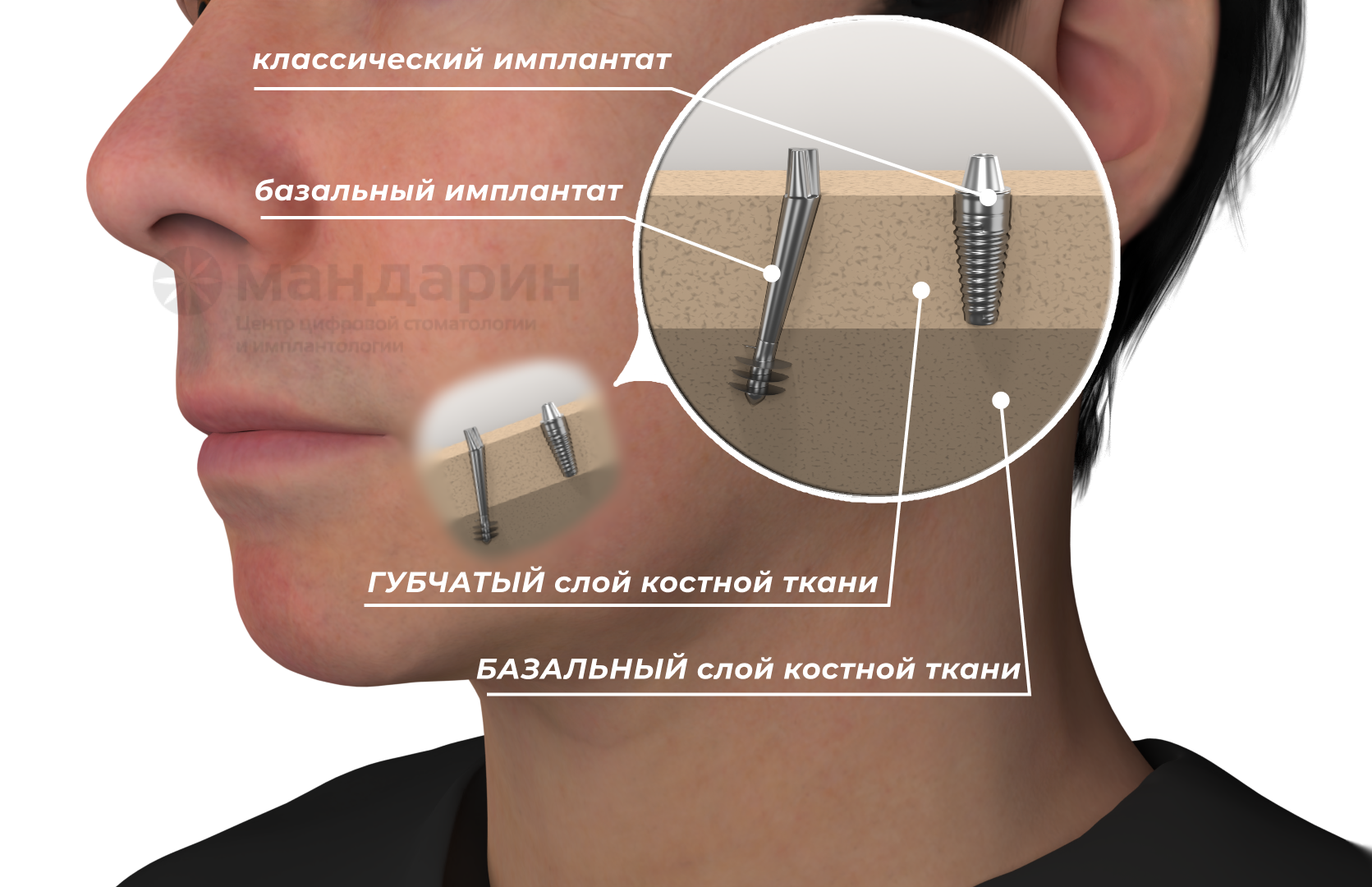 схема базальной имплантации.png