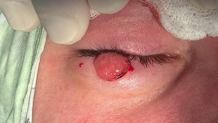 Владимирские врачи удалили подростку гигантский ячмень на глазу